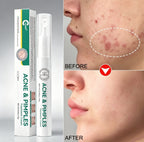 Acne Spot Treatment Pen Rapid Pimple Treatment for Clear Skin OEM Private Label
