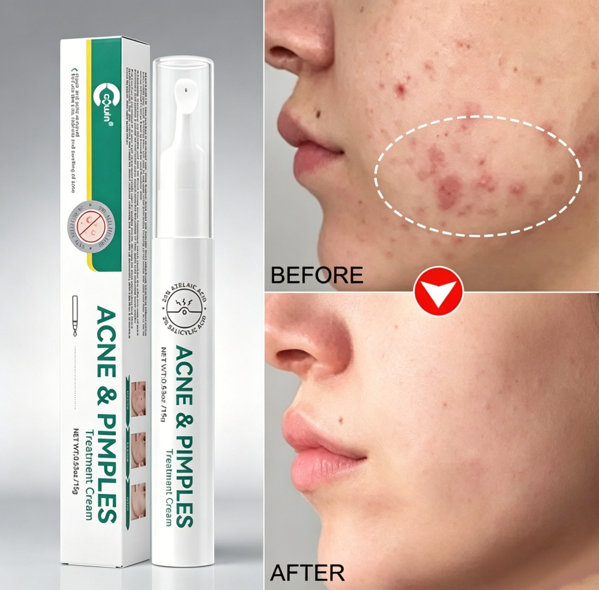 Acne Spot Treatment Pen Rapid Pimple Treatment for Clear Skin OEM Private Label