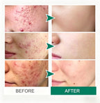 Acne Spot Treatment Pen Rapid Pimple Treatment for Clear Skin OEM Private Label