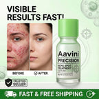 Acne Spot Treatment Serum 10ml Overnight Pimple Care, Oil Control Blemish Relief